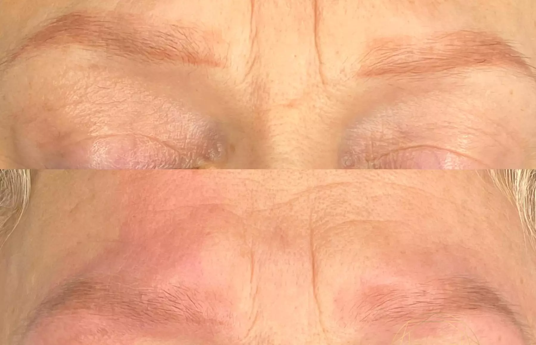 Laserowe oraz bezlaserowe usuwanie makijażu permanentnego brwi i ust