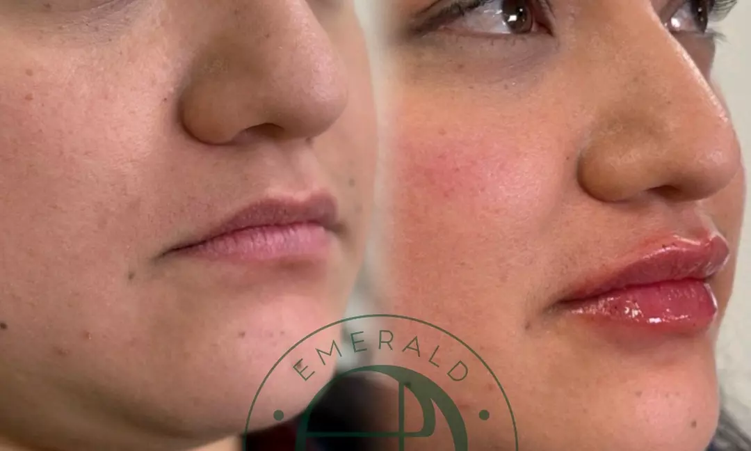 Luxe filler- of botoxbehandeling bij Emerald Aesthetic Clinic