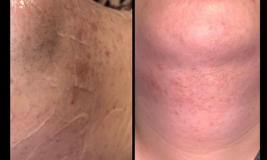 Image 2: Diodenlaser-Haarentfernung für Achseln, Intimbereich od. Unterschenkel