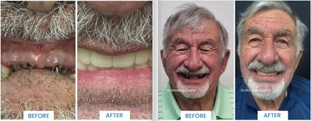 Xray and Doctor Consultation for Same Day Dental Implants, All on X, Snap on Denture - Sunnyvale Dental CAre