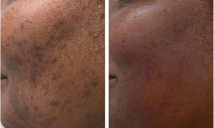 one 45 minute face microdermabrasion - aden laser llc