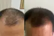 Regrow & Revive Your Hair with a 90-Min Hair Loss & Rejuvenation Treatment (Up to 65% Off) at Pure Hair Spa - Second Medium