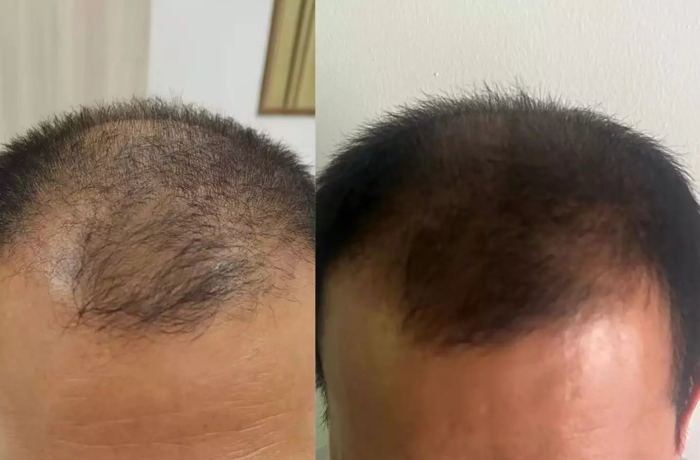 Revitalize Your Hair: 90-Min Hair Loss & Rejuvenation Treatment