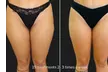Green Laser Lipo Fat Reduction - Up To 4 inches Loss (Up To 48% Off) - Second Medium