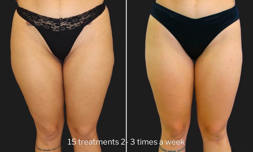 Image 5: Green Laser Lipo Fat Reduction - Up To 4 inches Loss