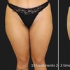 Image 5: Green Laser Lipo Fat Reduction - Up To 4 inches Loss