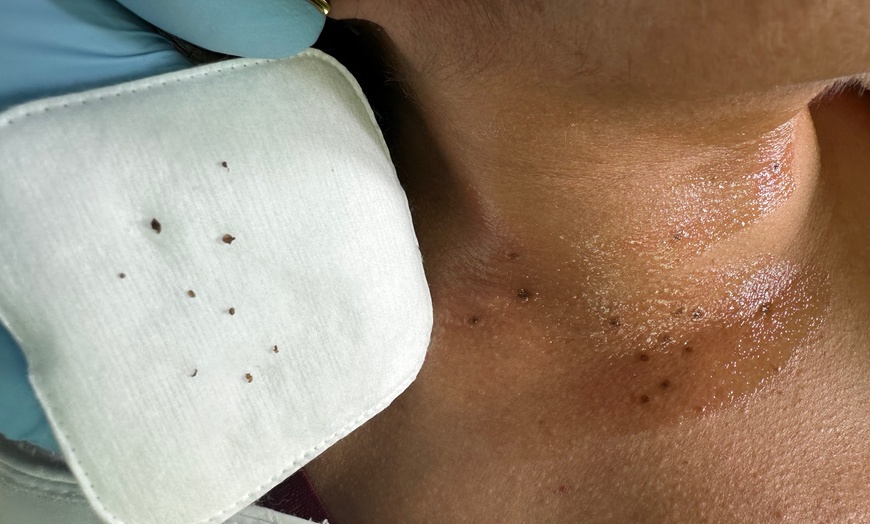 Image 5: Remove Up To 10 Skin Tags, Moles, Warts Or Milia Up To 2mm