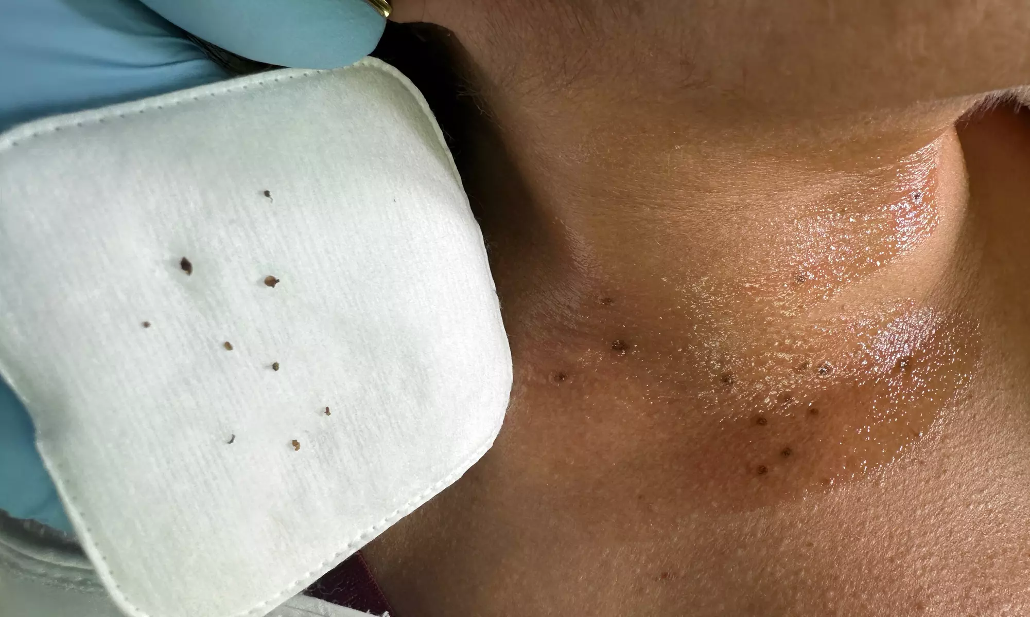 Remove Up To 10 Skin Tags, Moles, Warts Or Milia Up To 2mm