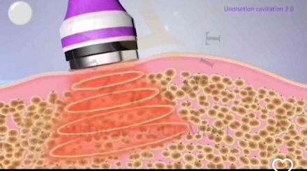 One 60 min Radio-Frequency Skin-Tightening/ Rejuvenating Treatment - Venus