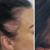 Image 7: Scalp Micropigmentation Hair-Loss Treatment - Crown, Front, or Filler