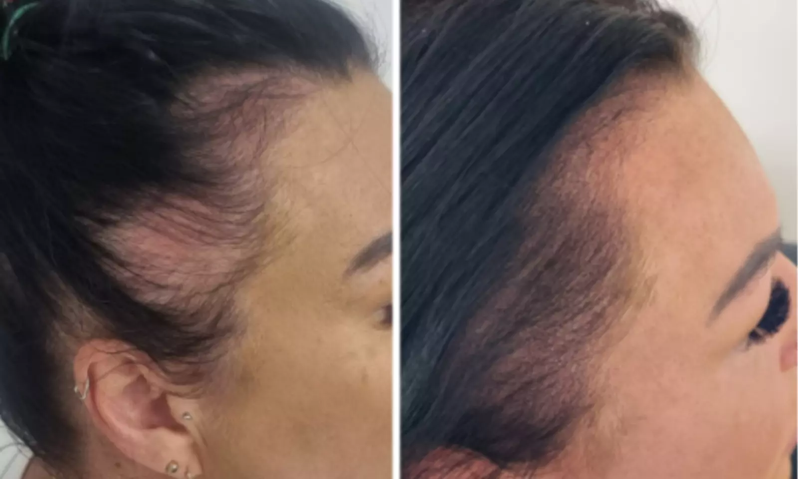 Scalp Micropigmentation Hair-Loss Treatment - Crown, Front, or Filler (Density Effect) - Women/Men(Up to 44%Off) - Second Medium