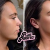 Image 8: Up to 68% Off on Injection - Dermal Filler at Pretti Purrfect