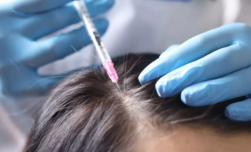 1 sesión de mesoterapia inyectada facial o capilar para 1 persona