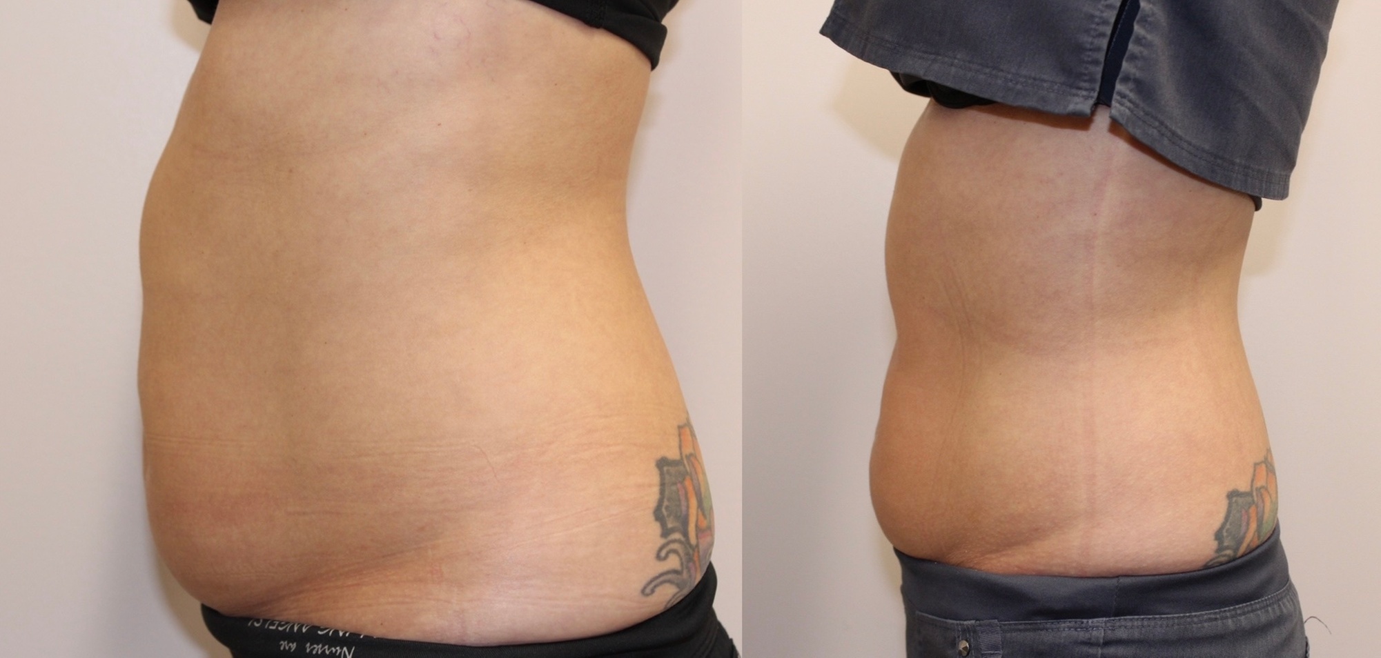 Up to 85% Off on Fat Reduction - Non-Branded at Beautiful skin by Angela