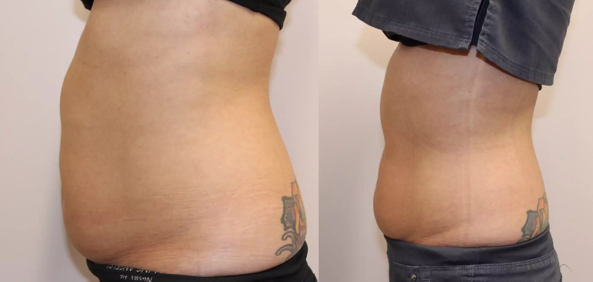 Up to 85% Off on Fat Reduction - Non-Branded at Beautiful skin by Angela - Primary Image