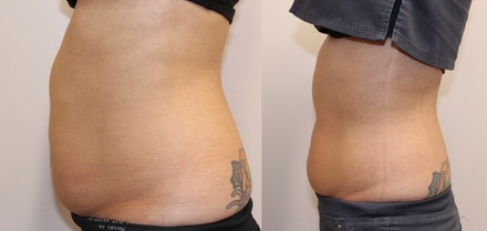 One Cavi-Lipo Treatment - Beautiful skin by Angela