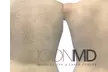 Up to 94% Off Laser Hair Removal Icon MD Medical Spa Plus Laser Center - Second Medium