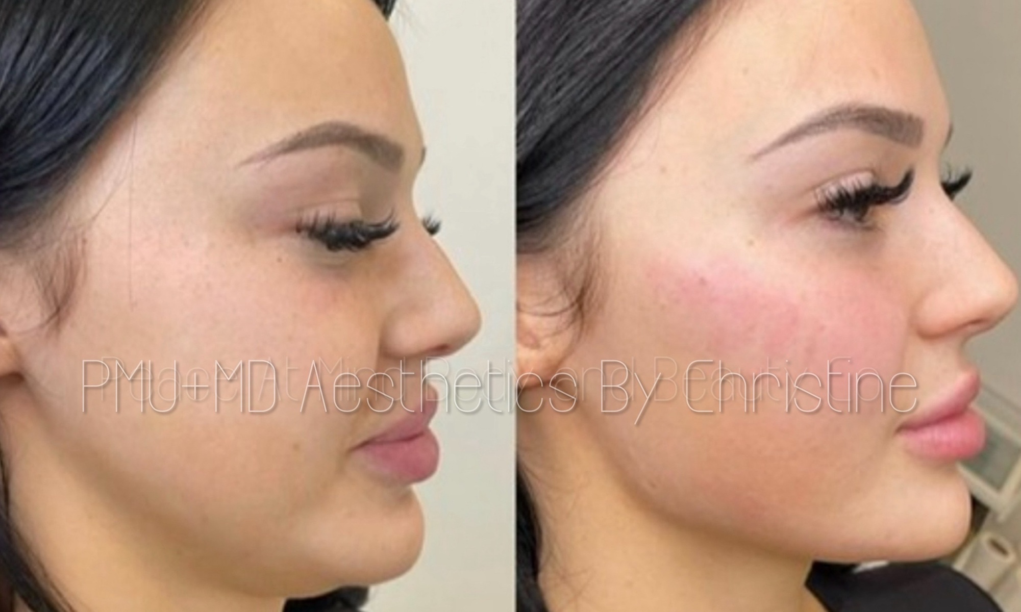 Up to 43% Off on Juvederm Injection - at PMU MD Aesthetics