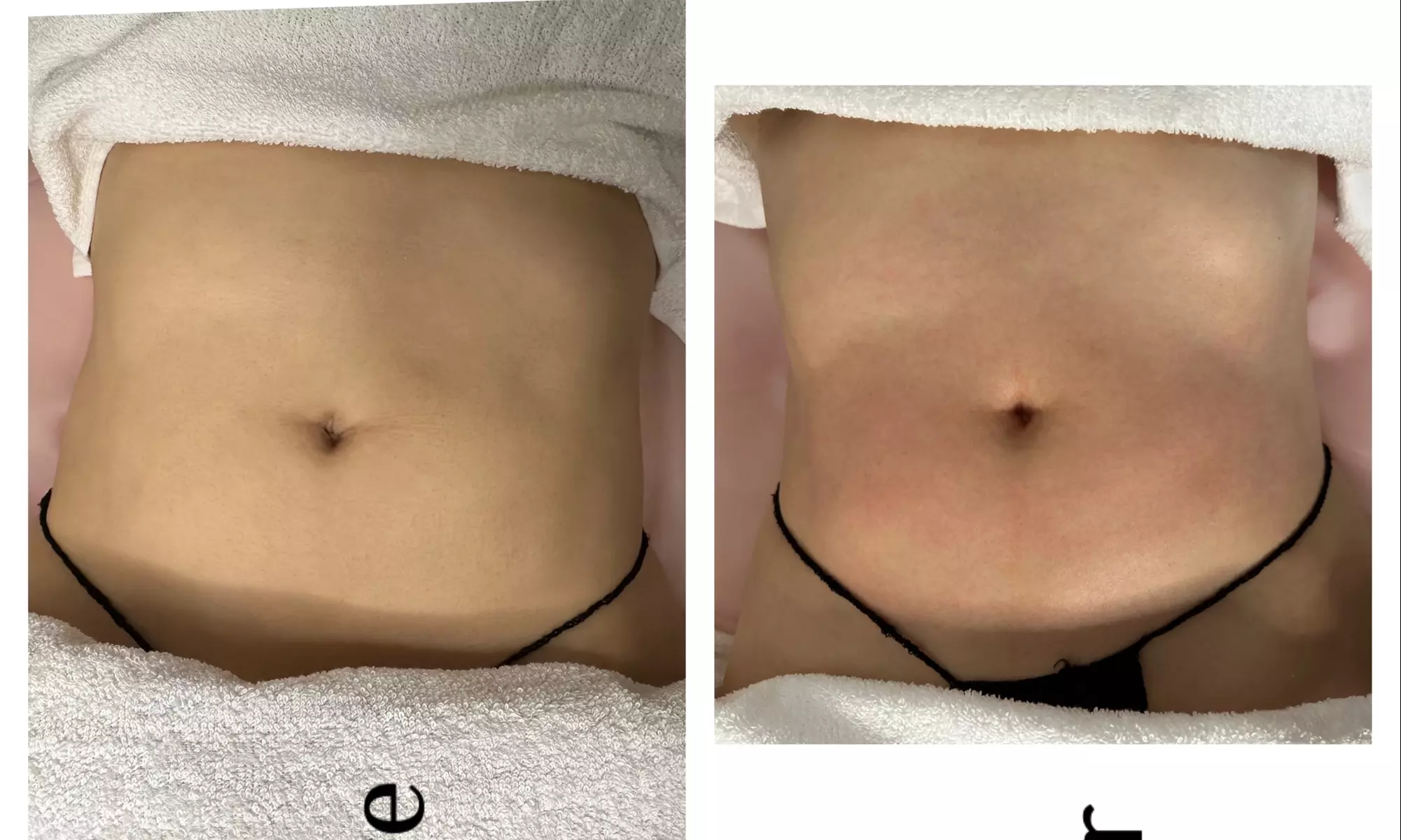 Ultrasonic Body Sculpting Sessions at Dyamond sculpted
