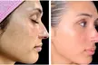 One or Three Sessions of TetraPRO or CoolPeel CO2 Fractional Laser on Choice of Treatment Areas (Up to 50% Off) - Second Medium