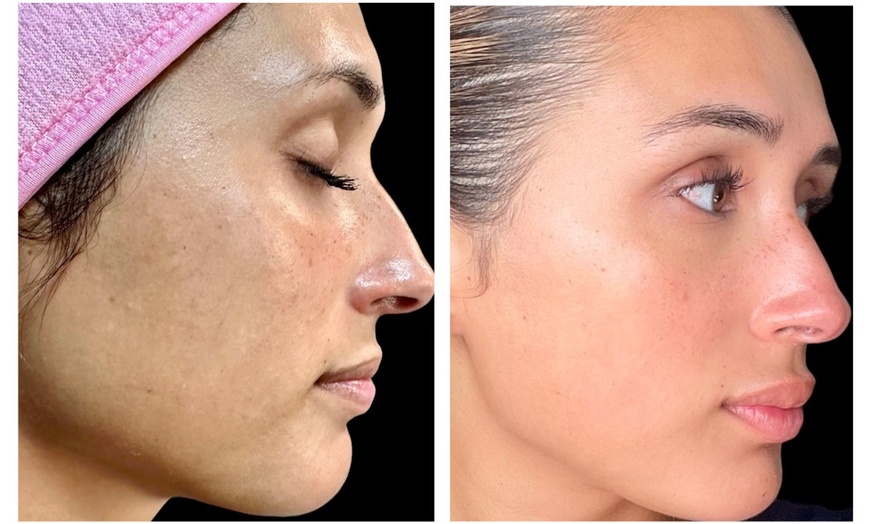 Image 3: One or Three Sessions of TetraPRO or CoolPeel CO2 Fractional Laser on Choice of Treatment Areas (Up to 50% Off)