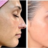 Image 3: One or Three Sessions of TetraPRO or CoolPeel CO2 Fractional Laser on Choice of Treatment Areas (Up to 50% Off)