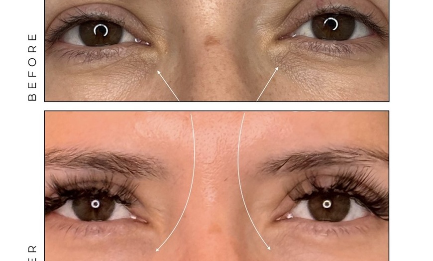 Image 1: Up to 71% Off on Dark Circle/Under Eye Treatment at MycroAesthetics