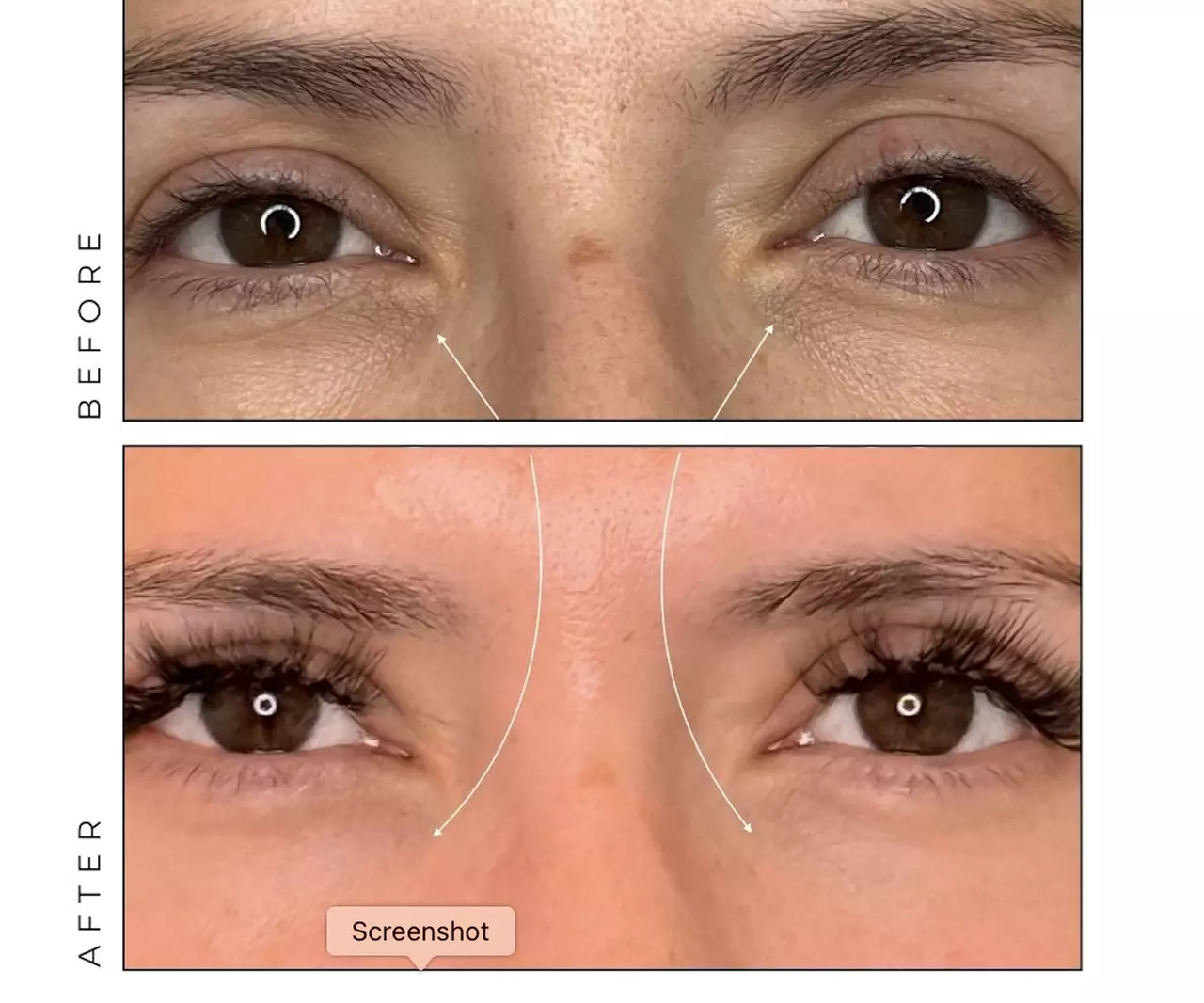 Revitalize Your Look w/ One, Two or Three Under Eye Restoration w/ PRP