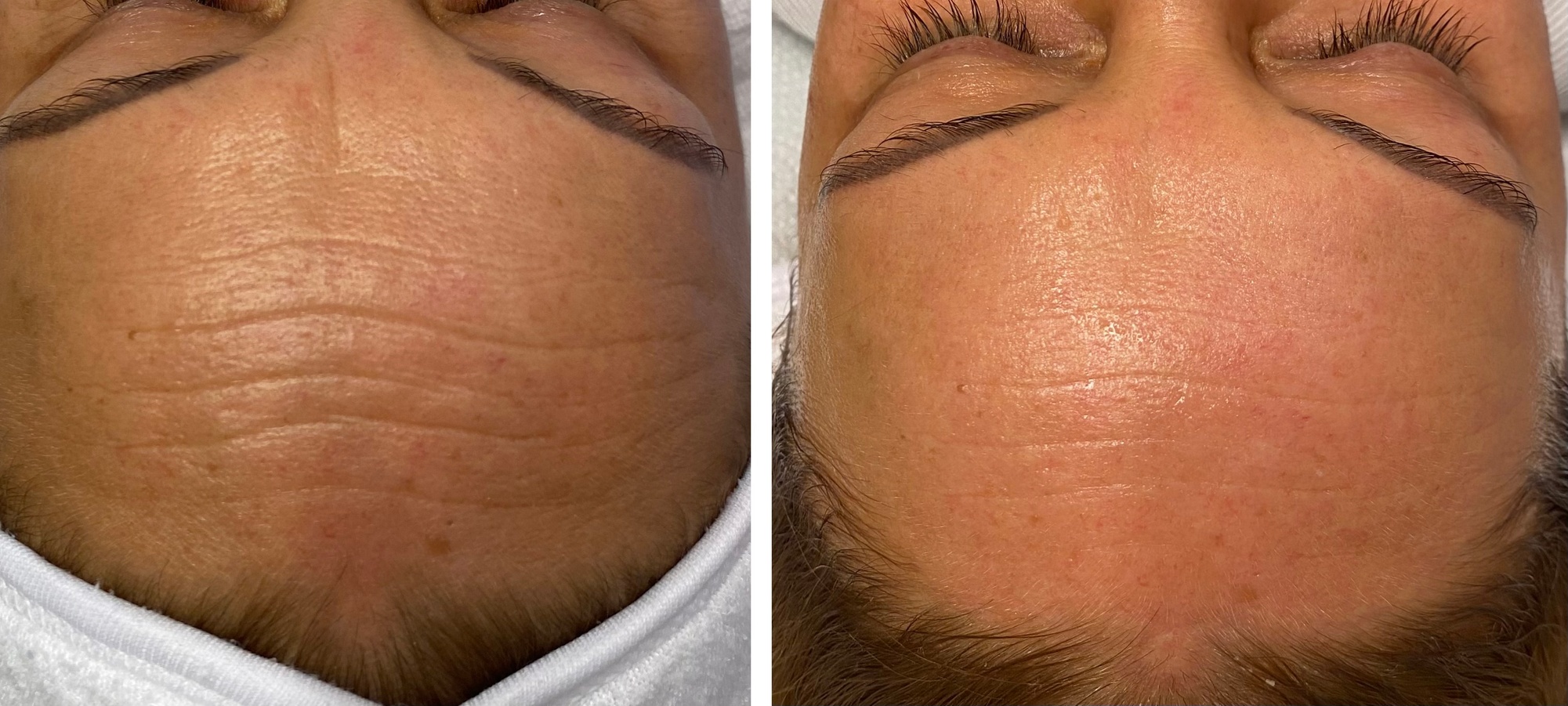 Enzym-Hauterneuerung & Serum-Therapie, optional mit Microneedling