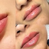 Image 4: Up to 61% Off on Injection - Dermal Filler at Skin Treat Aesthetics