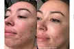Rejuvenate with Procell Therapies: Face & Neck or Stretch Marks & More (Up to 37% Off) at Nouveau Toi Med Spa - Second Medium