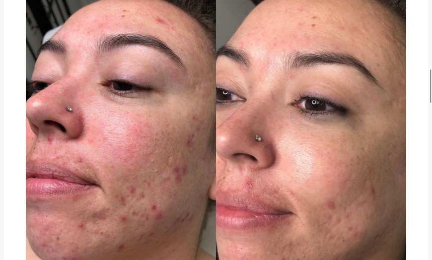 Image 3: Rejuvenate: Procell Therapies: Face & Neck or Stretch Marks & More