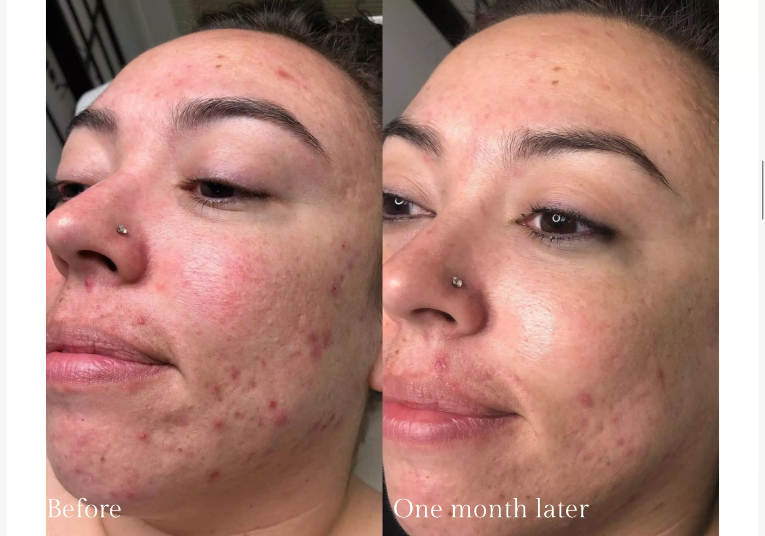 Rejuvenate: Procell Therapies: Face & Neck or Stretch Marks & More
