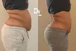 Redefine Body with One, Four or Eight Fat Reduction Sessions at Derma Luxe Aesthetics (Up to 55% Off) - Second Medium