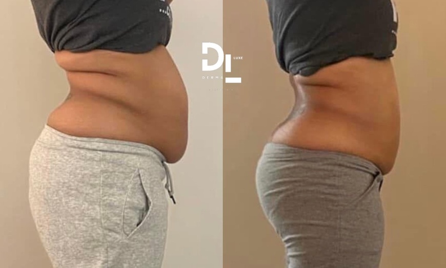 Image 2: Redefine Body with One, Four or Eight Fat Reduction Sessions