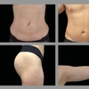 Image 4: Up to 76% Off Electromagnetic Sculpting Treatment