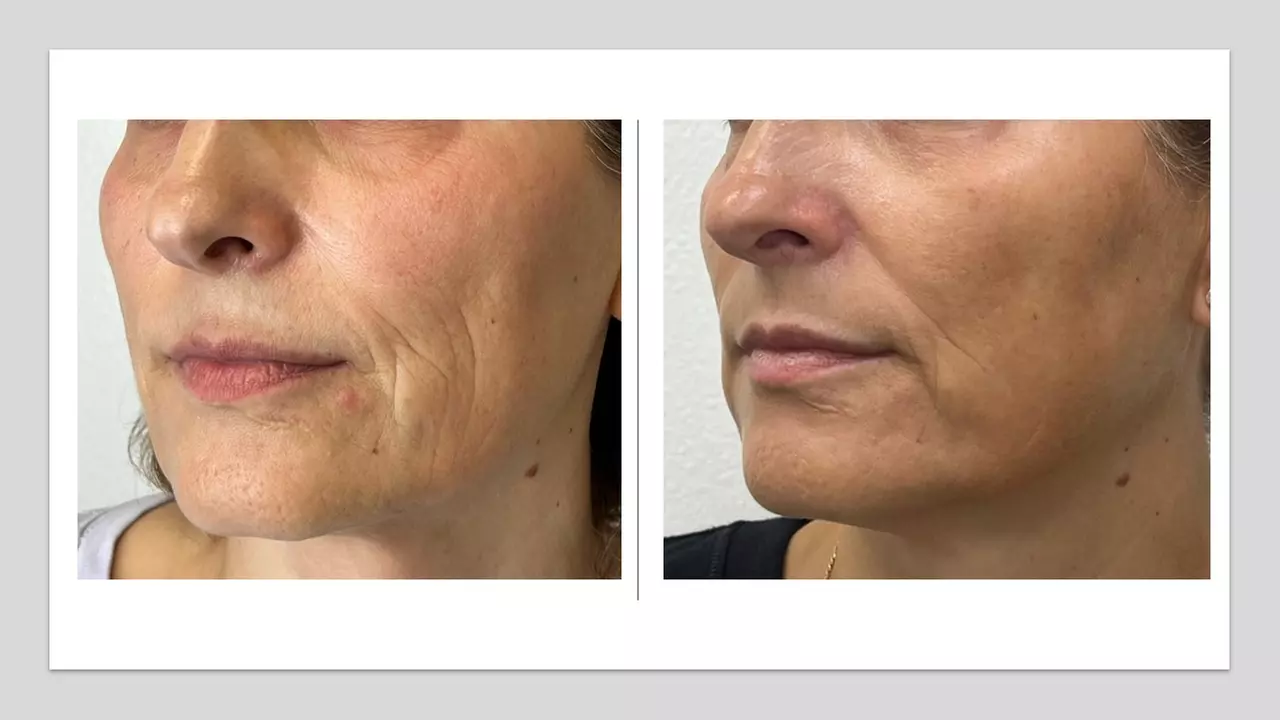 Up to 60% Off on Micro-Needling with PRP Platelet Rich Plasma at EternaMD