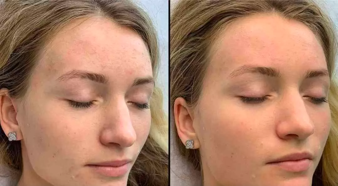 Up to 70% Off on Chemical Peel at Lotus Longevity