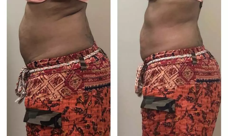 1 or 3 Cryo Slimming Sessions + Optional Full Body Red Light Therapy