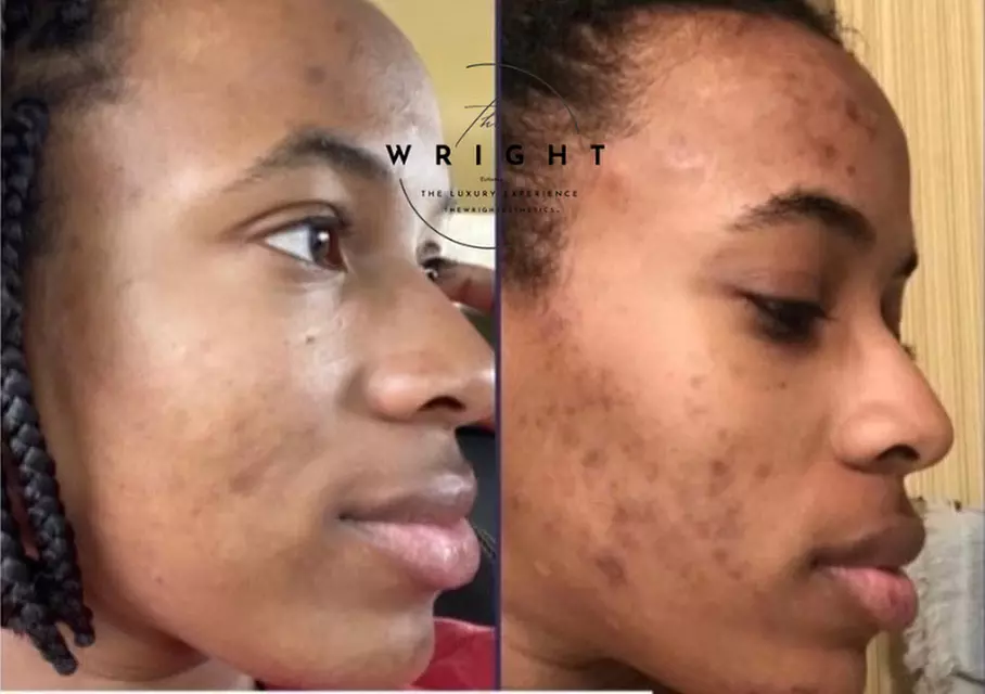 Experience rejuvenating in spa facials at The Wright Esthetics with options for up to 49% off.