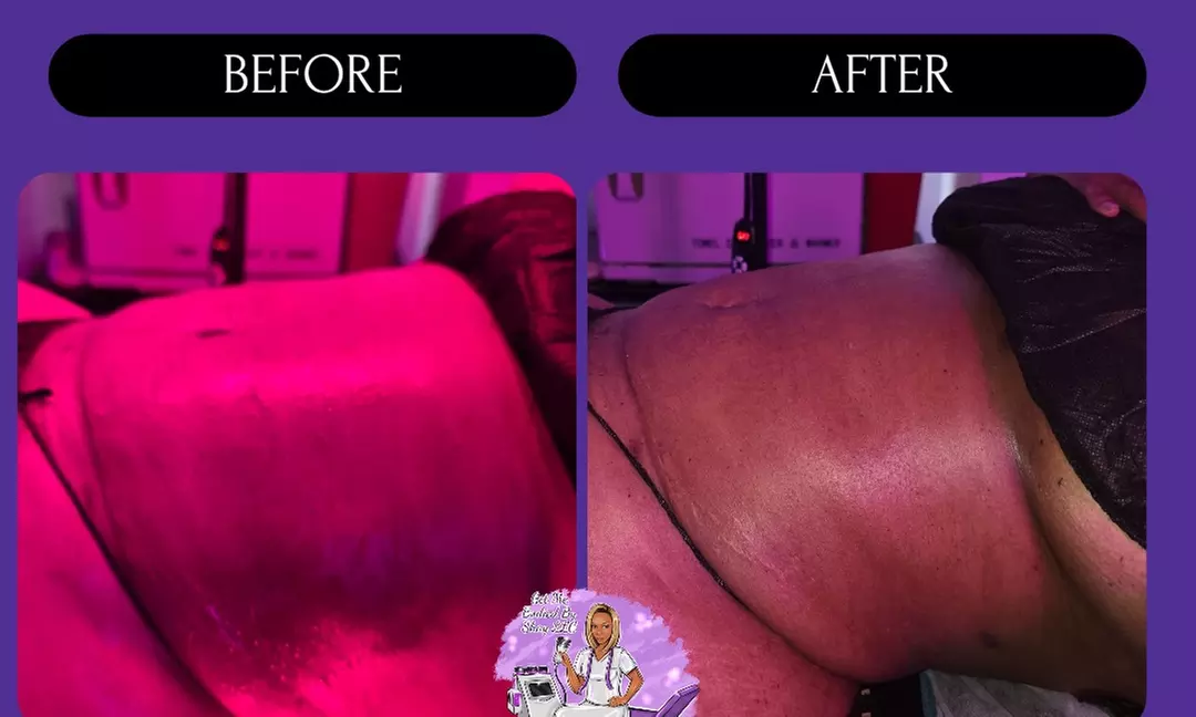 Post-Op Lymphatic Drainage Massages with Optional Wood Therapy