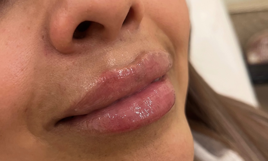 Image 3: Smooth & Contour: One or Full CC Syringe of Revanesse Versa Filler
