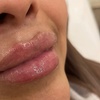 Image 3: Smooth & Contour: One or Full CC Syringe of Revanesse Versa Filler