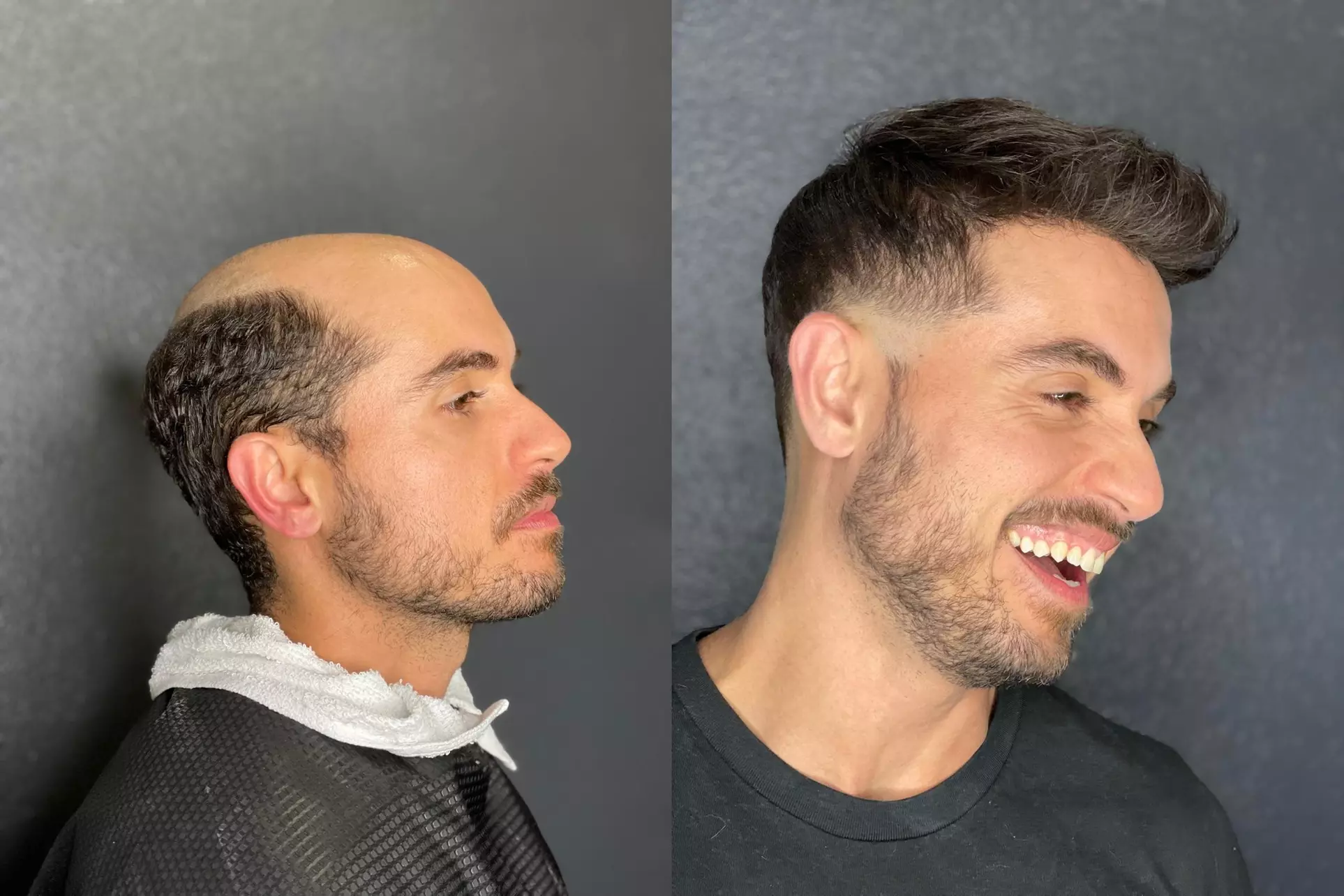 Up to 45% Off on Hair Restoration - Non-Surgical at Strandly hair