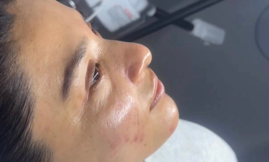 Image 3: One or Three Non-Surgical Face Lift: RF, Ultrasound & Cryo LED Facial 