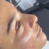 Image 3: Up to 30% Off on Facelift - Non-Surgical at Prasada skin