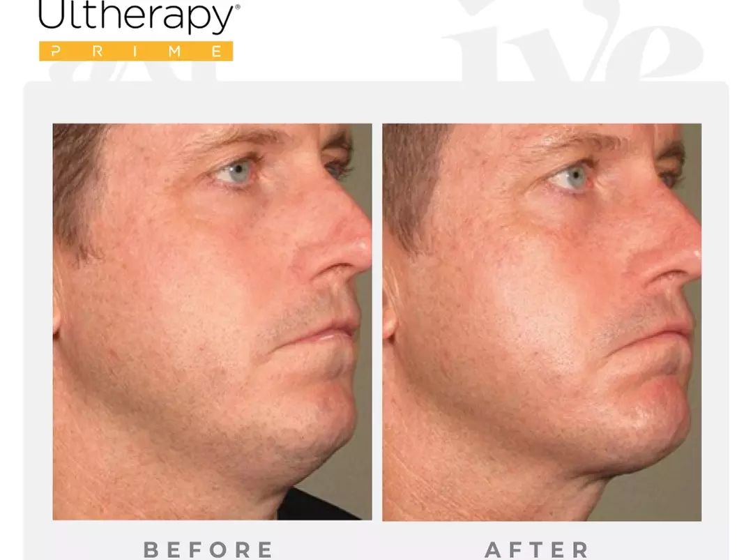 Ultherapy Prime - Full or Half Face & Neck Ultrasound at IVE MEDICAL SPA (Up to 50% Off) - Second Medium