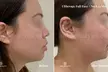 Experience skin lifting and tightening at One Beauty Aesthetics with Ultherapy treatments for chest or neck, up to 60% off - Second Medium