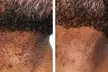 1 or 2 Laser Skin Resurfacing Sessions for Full Face or 1 Instant Razor Bump Removal & More Up to 93% Off - Second Medium