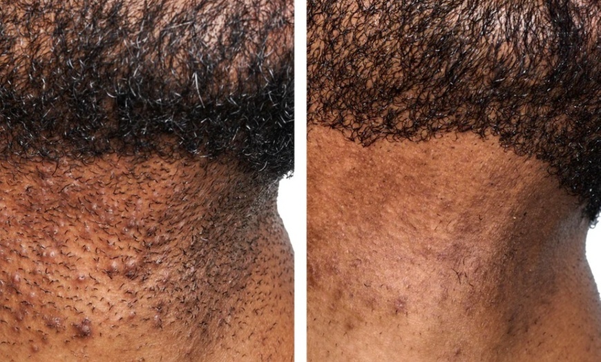 Image 2: One or Two Laser Skin Resurfacing Sessions for Full Face & More 